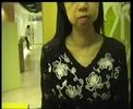 Goiter minimization under Thyroid Throu - Case1 after