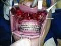 Ortognática - Cirurgia da maxila - Carbomaxilofacial