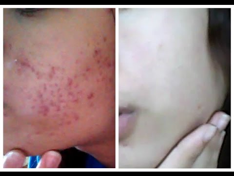 how to use epiduo properly