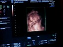 Baby Richard AKA Andy