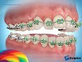 Broken Brackets (Loose Braces)