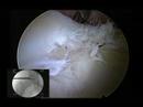 Hip Labral Repair