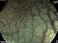 ENFERMEDAD CELIACA ENDOSCOPIA 2