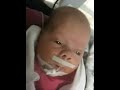 Off CPAP no. 2