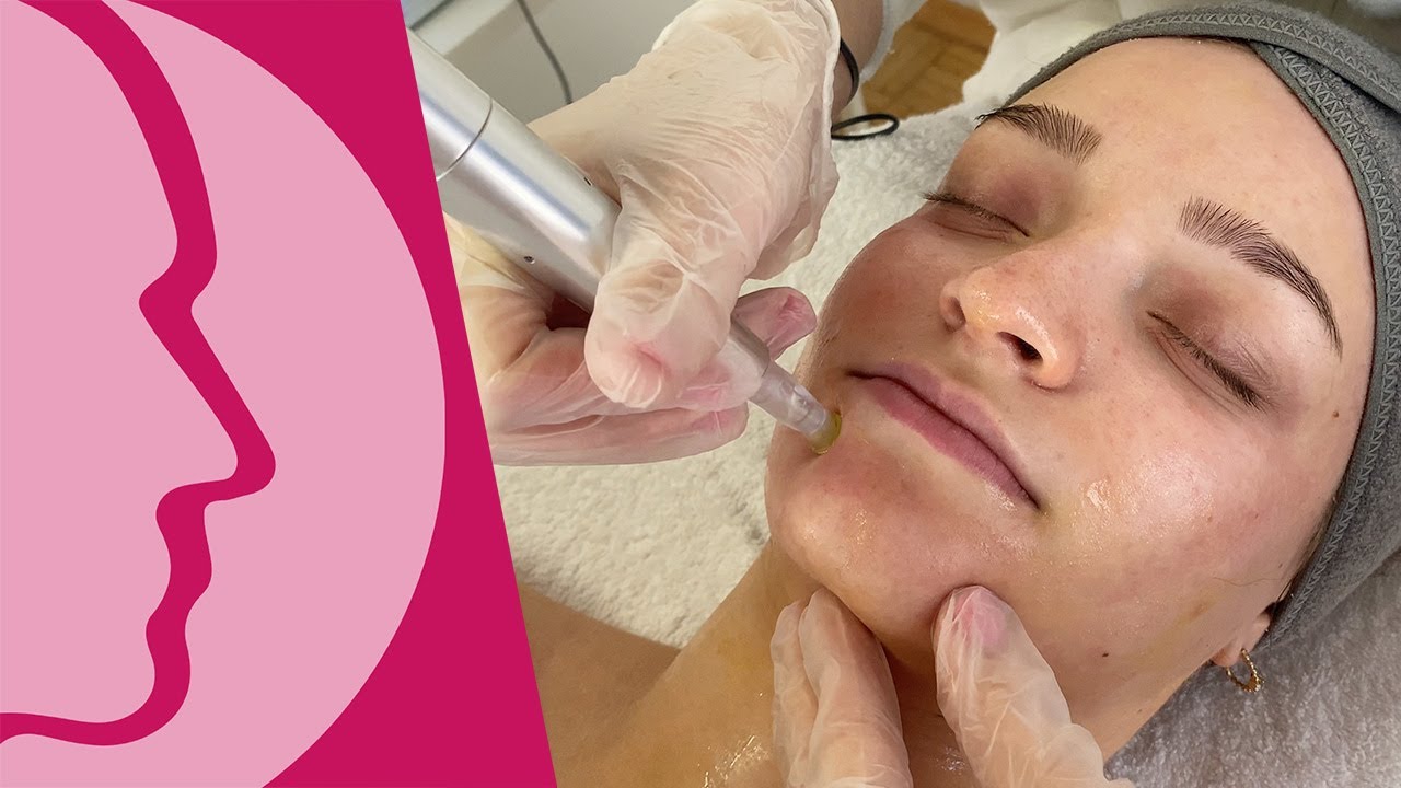 Praxisunterricht Microneedling