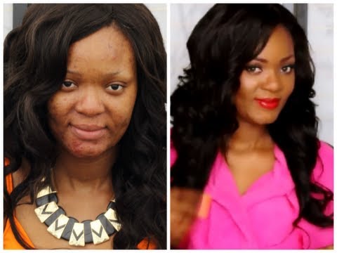 How to Cover Acne/Pimples,Scars,Darkspots,Blemishes(Makeup Foundation Routine)