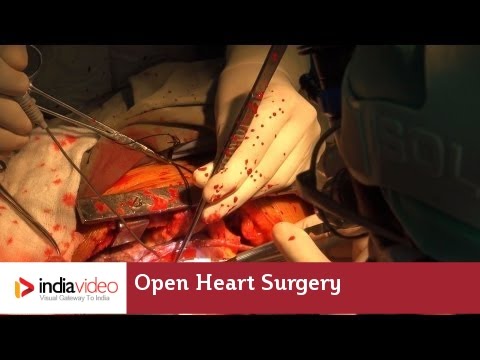 how to perform heart surgery