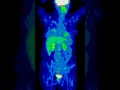Breast - Pre Treatment PET/CT Breast - Pre Treatment PET/CT
