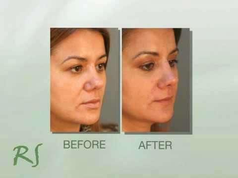 to Nasolabial Folds "Smile to Nasolabial Folds "Smile