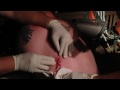 Matt's Gnarly Cyst. (language warning)