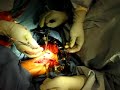 Tarsal tunnel decompression