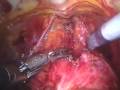 Prostate Excision Using Robotic-Assisted Method Prostate Excision Using Robotic-Assisted Method