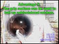 cataract surgery soft IA tip for cortex by Uday Devgan MD cataract surgery soft IA tip for cortex by Uday Devgan MD