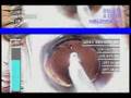 Soft IA Tip - Cataract Surgery Soft IA Tip - Cataract Surgery