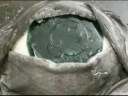 LASIK Surgery LASIK Surgery