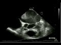 thrombus