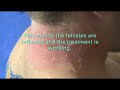 Laser Hair Removal - Male Patient Neck Laser Hair Removal - Male Patient Neck