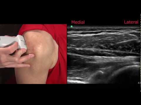 Supraspinatus tendonitis corticosteroid injection