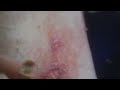 Wheelchair style - Nasty 2nd Degree Burn Audio: Dr. Visit yesterday (Part 5) - L1 injury 4-10-12