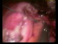 Esplenectomia de Bazo Supernumerario por laparoscopia II