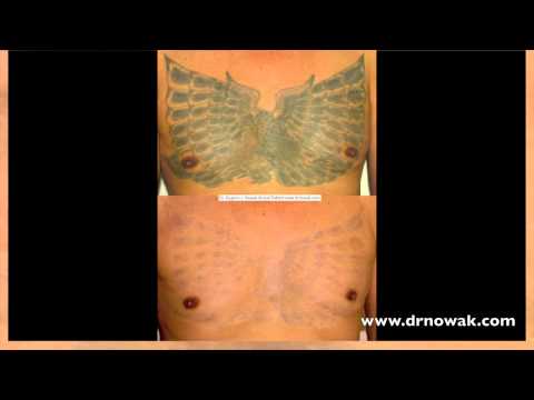 tattoo removal san diego nowak aesthetics tattoo removal san diego nowak aesthetics