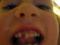 Self video of loose tooth