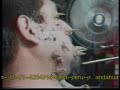 Moxibustion Video 8