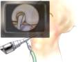PreOp® Patient Education: Arthroscopic Meniscus of Knee 1