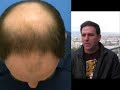 Hair Transplant Testimony of NicNitro - Dr Hasson Patient