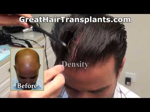 Dr. Brett Bolton Hair Transplant Results_Plastic surgery, liposuction. Best of all time