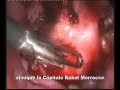 laparoscopic polymyomectomy using a knew morcellator