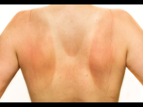 how to relieve the pain of a sunburn