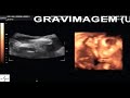 GRAVIMAGEM 14 (ULTRA-SOM 3D 4D) GRAVIMAGEM 14 (ULTRA-SOM 3D 4D)