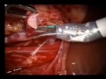 Robotic Pediatric Surgery