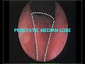TURP  trans urethral resection of prostate
