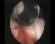 TURP trans urethral resection of prostate