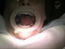 Implant Surgery #19,20