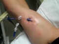 PICC Line Dressing Change