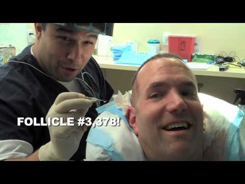 how to do hair transplant yourself