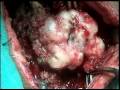 Osteochondroma Of Vertebral Column Excision