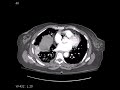 CT Pulmonary Embolism Pulmonary Embolism