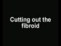 Leiomyomectomy