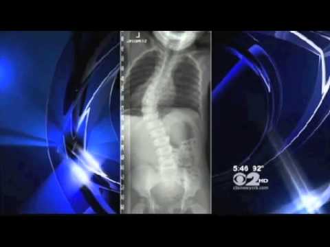 how to cure scoliosis