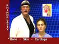 Rinoplasty