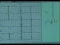 Electrocardiograma en reposo Electrocardiograma en reposo