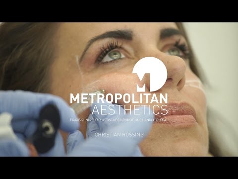 Faltenunterspritzung mit Hyaluronsäure in Berlin - Wangen, Nasolabialfalte und Mundwinkelkorrektur