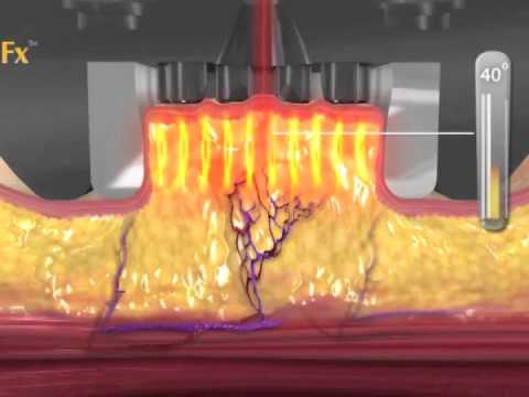 how to eliminate ama