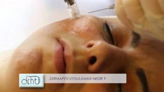 Dr Hüseyin Tırman - Dermapen Uygulaması Nedir?