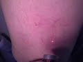 Transdermal LASER