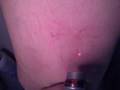 Transdermal LASER